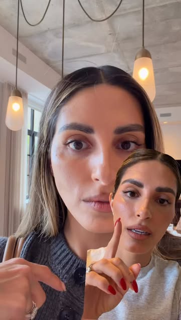Fat grafting under the eyes: day by day. #fatgrafting #undereyefatgrafting #undereyefattransfer #und