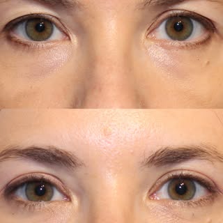 Before and 2 months after temporal brow lift + upper blepharoplasty on the beautiful @wemetatacme @l