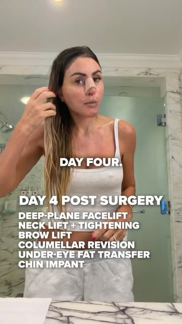 Day 4 of my facelift recovery… and apparently the nurse leaving means I’m the nurse now. 😅

I final