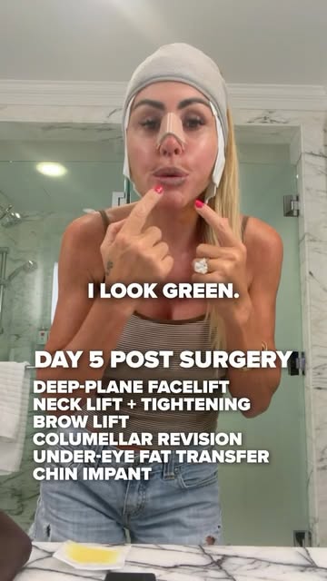 Day 5 of my facelift recovery and apparently this is the part where people start thinking…

“What th