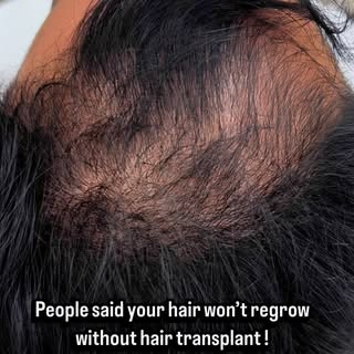 Hair Thinning? What would you do??

From thinning to winning — PRP isn’t magic, it’s science 🧬 
Thi