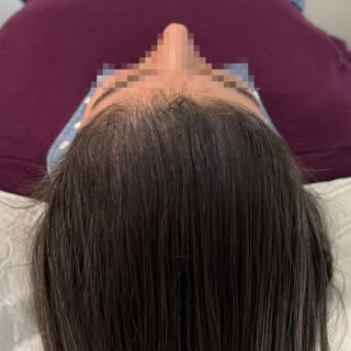 No more hiding! Scalp micropigmentation offers a permanent, low-maintenance way to reclaim the look 