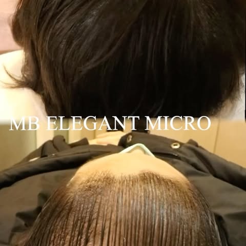 No more hiding! Scalp micropigmentation offers a permanent, low-maintenance way to reclaim the look 