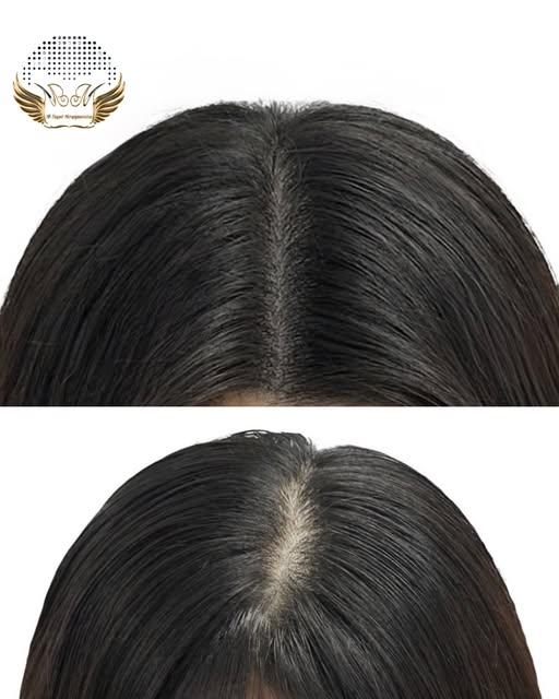 No more hiding! Scalp micropigmentation offers a permanent, low-maintenance way to reclaim the look 