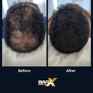 Receding hairlines, weakened strands, and that feeling of losing more than just hair — losing part o