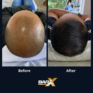Receding hairlines, weakened strands, and that feeling of losing more than just hair — losing part o