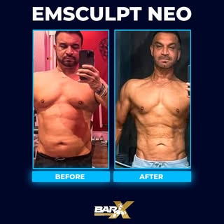 EMSCULPT NEO is a revolutionary treatment designed to help you burn fat and build muscle in the fast