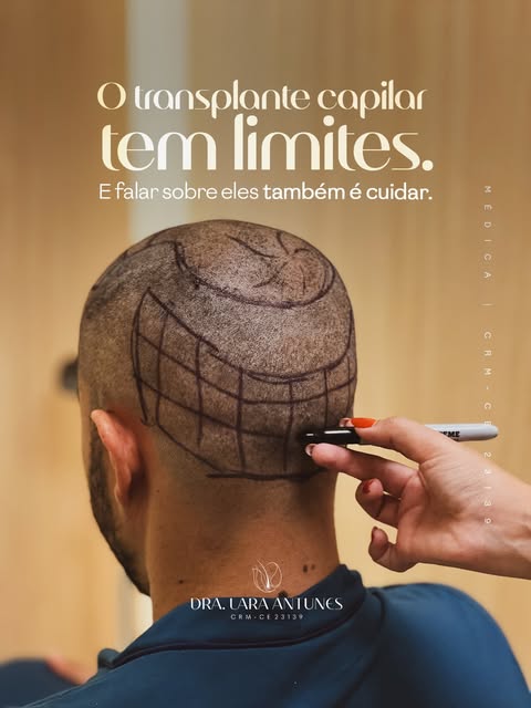 Cuidar também é falar com transparência.

O transplante capilar possui possibilidades, mas também li
