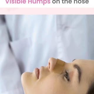 A new you through Rhinoplasty at Aura Wellness & Aesthetics, where our skilled surgeons can refine a