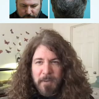 Hair transplant patient talks about his experience with Dr. Sara Wasserbauer and restoring his hair.