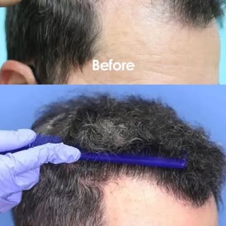 Natural hairline restoration. It's essential to transition the hair density and close the temporal z