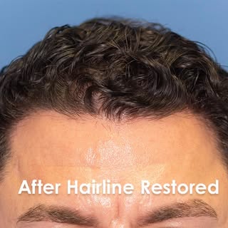 Natural Hairline Restoration – 2800 FUE Hair Grafts