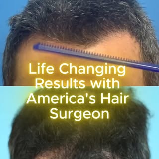 Beautiful hair transplant result and comb-thru!