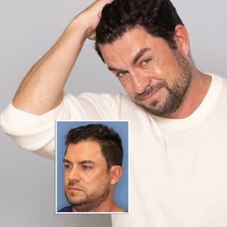 #1 What is a Hair Transplant? Learn more at - https://californiahairsurgeon.com/