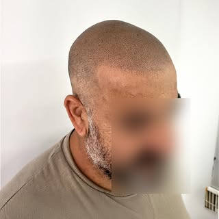 Con nuestro efecto rapado, este cliente recuperó su línea capilar con un resultado 100% natural 🔝. 