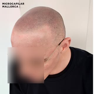 Este cliente ha recuperado su línea capilar con nuestro exclusivo efecto rapado , logrando una apari