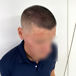 Gracias a la micropigmentación capilar, conseguimos simular mayor volumen en las áreas de cabello de