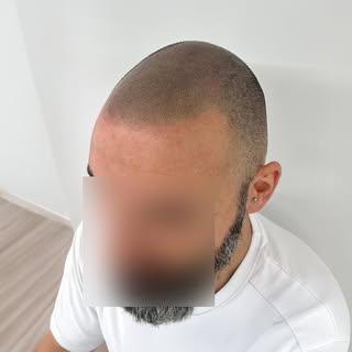 La micropigmentación capilar le devolvió su estilo y confianza, luciendo un look renovado que parece