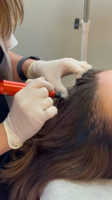 O MMP Capilar é um procedimento que utiliza microperfurações para promover a aplicação de ativos dir
