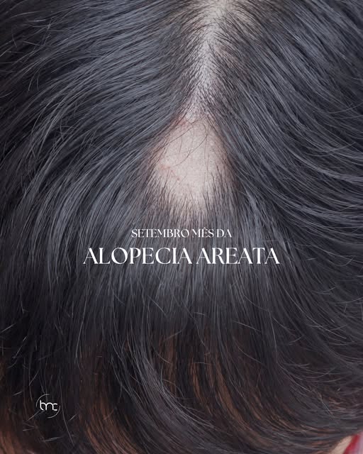 A alopecia areata é uma condição que pode causar queda de cabelo em áreas bem delimitadas, formando 