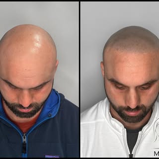 Another soft and natural Coverage treatment. It's amazing how recreating a frame to your face can dr