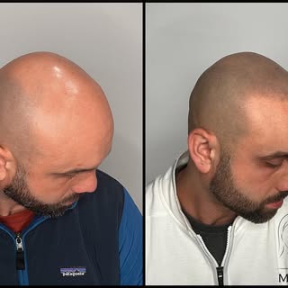 Another angle—soft and natural.

▪️Ready to get your treatment done or want more information? Reach 