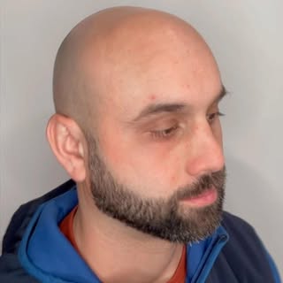Scalp Micropigmentation coverage treatment before and after. Thousands of individual impressions com