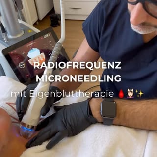 Radiofrequenz Microneedling mit Eigenbluttherapie enthüllt strahlende Haut 🩸💆🏻‍♀️✨

Das Radiofreq
