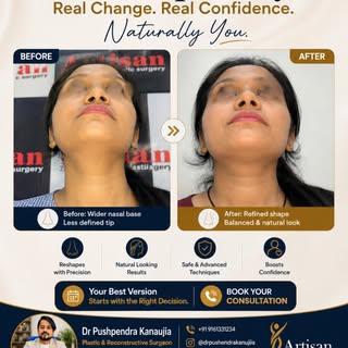 Your best version starts with the right decision. ✨

See the transformation: a refined nasal shape, 