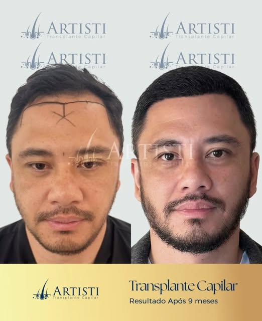 9 meses de evolução e uma mudança que já aparece tanto na região frontal quanto na coroa.

O transpl