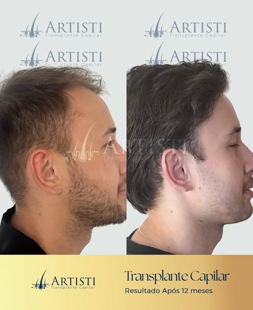 “Depois de um primeiro transplante frustrante, escolhi a Artisti para fazer o meu segundo.”

Mais do