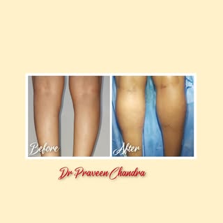 Leg transformation/ fat transfer to calf one time permanent  solution. 
For more information  contac