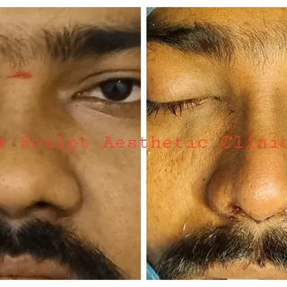 Rhinoplasty: saddle nose with bulbous  tip correction pre and post  op