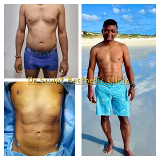 Abdominal etching/ sculpting/6 pack Ab