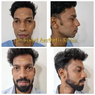 Rhinoplasty  pre and post op 6 months