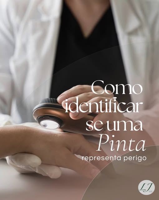 Nevos, mais conhecidos como “pintas” na pele podem mostrar alterações de alerta para o câncer de pel
