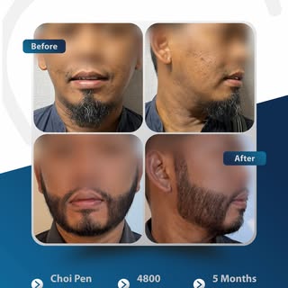 Turkish Technology. 4800 Grafts. 5 Months Later.

✨ 4800 grafts, 5 bulan setelah menjalani beard tra