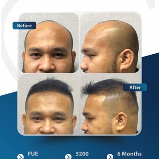 Teknologi Hair Transplant Turki 🇹🇷 Bukan AI. 5200 Grafts. After 6 Months.

✨ 5200 grafts, 6 bulan 