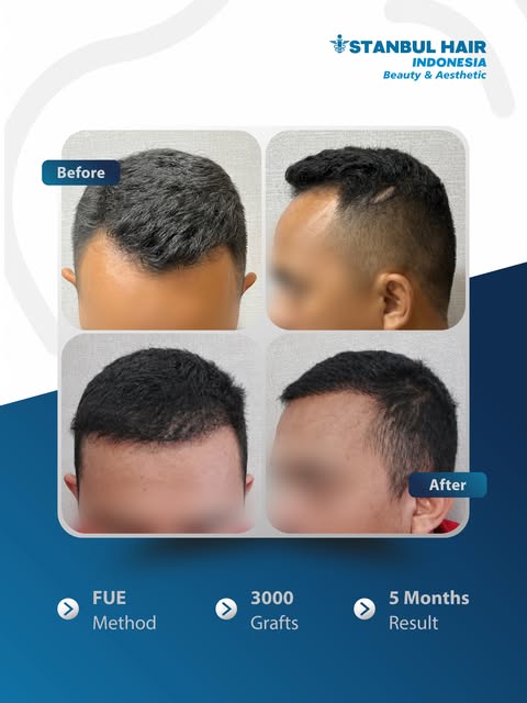 Bekas Luka di Kepala Bisa Ditutup dengan Hair Transplant. ✨

Bukan hanya untuk mengatasi kebotakan. 