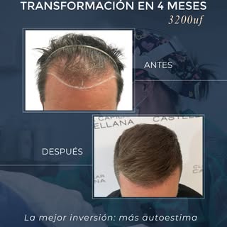 Hay decisiones de las uno jamás se arrepiente. Realizarse una cirugía capilar es una de ellas. 👌

4