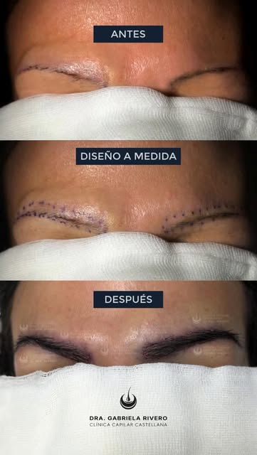 La magia de la Dra. Rivero: de unas cejas prácticamente inexistentes a una mirada completamente defi