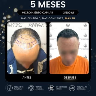 ✨ Solo 5 meses de evolución… y esto es solo el principio.

En un microinjerto capilar, la paciencia 