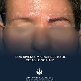 El detalle que cambia por completo la expresión.

Microinjerto de cejas en un paciente con cabello l