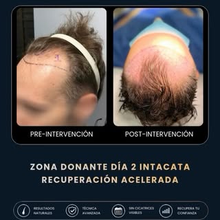 ¿Cómo es un microinjerto capilar de principio a fin? 👇

En este vídeo puedes ver el antes, el proce