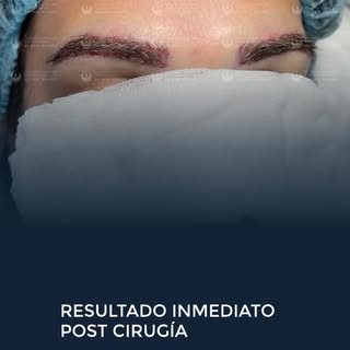 En un microinjerto de cejas, quién lo hace lo cambia todo.

La Dra. Rivero se ha convertido en una d