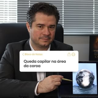 Quando alguém percebe que você fez um transplante capilar, geralmente não é por causa da técnica. É 