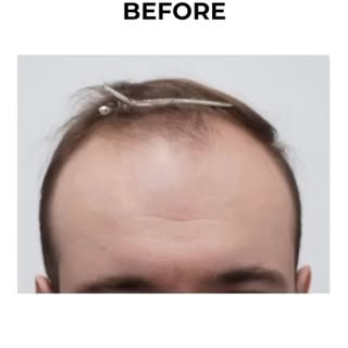 Here is a patient after 1yr on prescription
LLLT, Compounded Minoxidil, and Propecia, where his resu