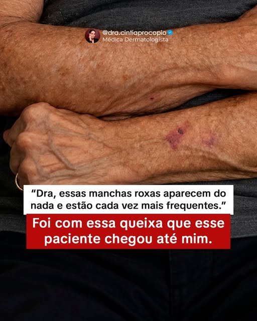 Para quem tem púrpura senil, alguns hábitos simples no dia a dia fazem muita diferença.

Hidrate a p