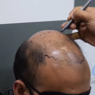 Hair today, gone tomorrow? Let’s talk about why balding happens and what you can do about it. Don’t 