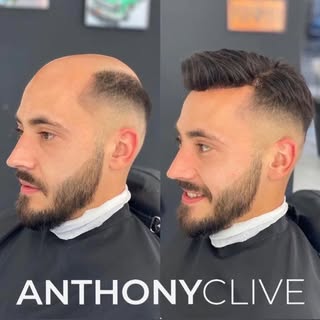 Before and after hair system transformation 🔥🔥